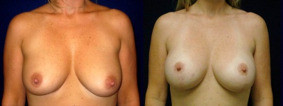 Frontal View - Breast Augmentation with Lift - Silicone Implants