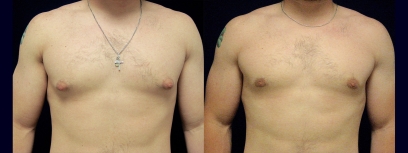 Frontal View - Male Breast Reduction Frontal View - Male Breast Reduction