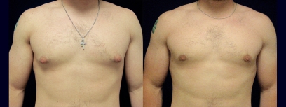 Frontal View - Male Breast Reduction