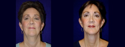 Frontal View - Facelift & Chin Implant Frontal View - Facelift & Chin Implant