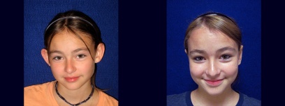 Fontal View - Otoplasty Fontal View - Otoplasty
