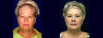 Frontal View - Facelift with Upper and Lower Eyelid Surgery and Browlift