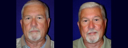 Frontal View - Facelift with Upper Eyelid Surgery and Browlift Frontal View - Facelift with Upper Eyelid Surgery and Browlift