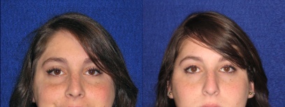 Frontal View - Rhinoplasty Frontal View - Rhinoplasty