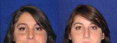 Frontal View - Rhinoplasty