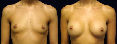 Frontal View - Breast Augmentation - Silicone Implants Frontal View - Breast Augmentation - Silicone Implants