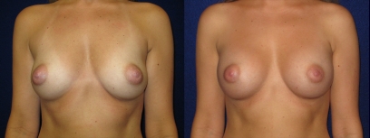 Frontal View - Breast Augmentation - Saline Implants