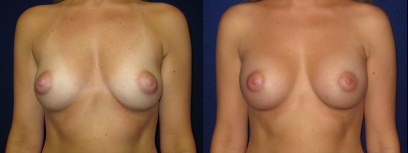 Frontal View - Breast Augmentation - Saline Implants Frontal View - Breast Augmentation - Saline Implants