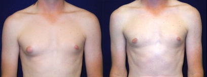 Frontal View - Male Breast Reduction