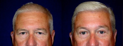 Fontal View - Upper Eyelid Surgery with Browlift Fontal View - Upper Eyelid Surgery with Browlift