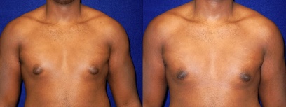 What do you think would be the cost of gynecomastia surgery in India? -  Quora