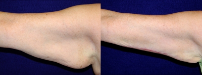 Frontal View - Right Arm - Arm Lift