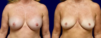 Frontal View - Breast Implant Removal Frontal View - Breast Implant Removal