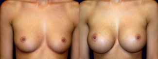 Frontal View - Breast Augmentation - Saline Implants