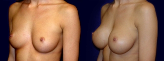 Left 3/4 View - Breast Augmentation - Saline Implants