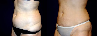 Left 3/4 View -Liposuction