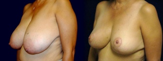 Left 3/4 View - Breast Reduction