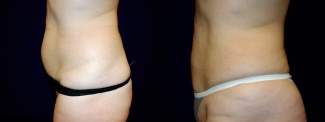 Left Profile View - Liposuction