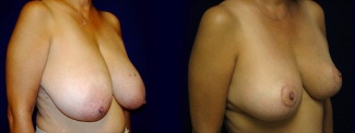 Right 3/4 View - Breast Reduction