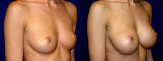 Right 3/4 View - Breast Augmentation - Saline Implants