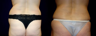 Back View - Liposuction
