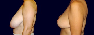 Left Profile View - Breast Reduction