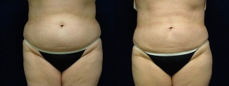 Frontal View - Liposuction