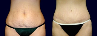 Frontal View - Tummy Tuck