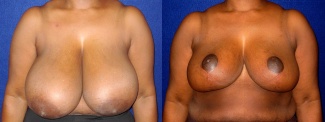 Frontal View - Breast Reduction