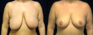 Frontal View - Breast Lift After Weight Loss