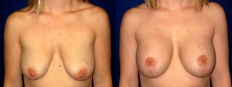 Frontal View - Breast Augmentation with Lift - Silicone Implants