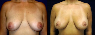 Frontal View - Breast Augmentation with Silicone Implants - Periareolar Mastopexy