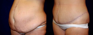 Frontal View - Circumferential Tummy Tuck After Massive Weight Loss