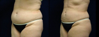 Left 3/4 View -Liposuction