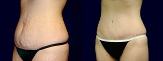 Left 3/4 View -Tummy Tuck