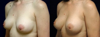 Left 3/4 View - Breast Implant Revision - Silicone Implants