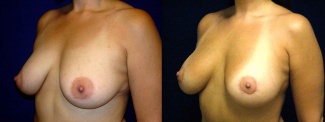 Left 3/4 View - Breast Augmentation with Silicone Implants - Periareolar Mastopexy