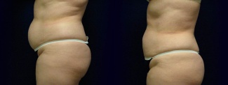 Left Profile View - Liposuction