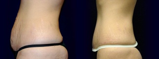 Left Profile View -Tummy Tuck