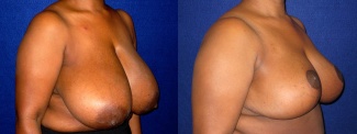 Right 3/4 View - Breast Reduction