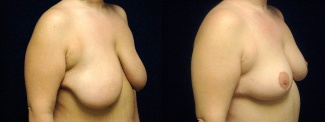 Right 3/4 View - Breast Lift After Weight Loss