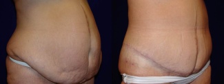 Right 3/4 View - Circumferential Tummy Tuck After Massive Weight Loss