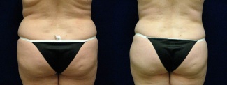 Back View - Liposuction