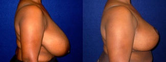 Right Profile View - Breast Reduction