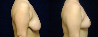 Right Profile View - Breast Lift After Weight Loss