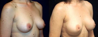 Right 3/4 View - Breast Implant Revision - Silicone Implants