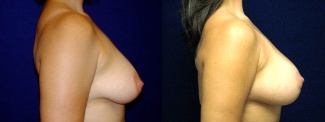 Right Profile View - Breast Augmentation with Silicone Implants - Periareolar Mastopexy