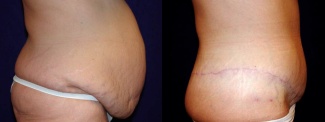 Right Profile View - Circumferential Tummy Tuck After Massive Weight Loss