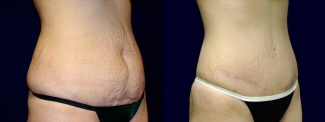 Right 3/4 View -Tummy Tuck