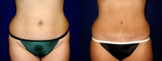 Frontal View - Tummy Tuck After Pregnancy